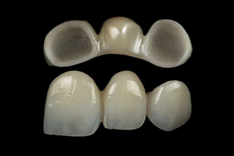 Restaurări Fixe Dentare (Coroane & Punți)