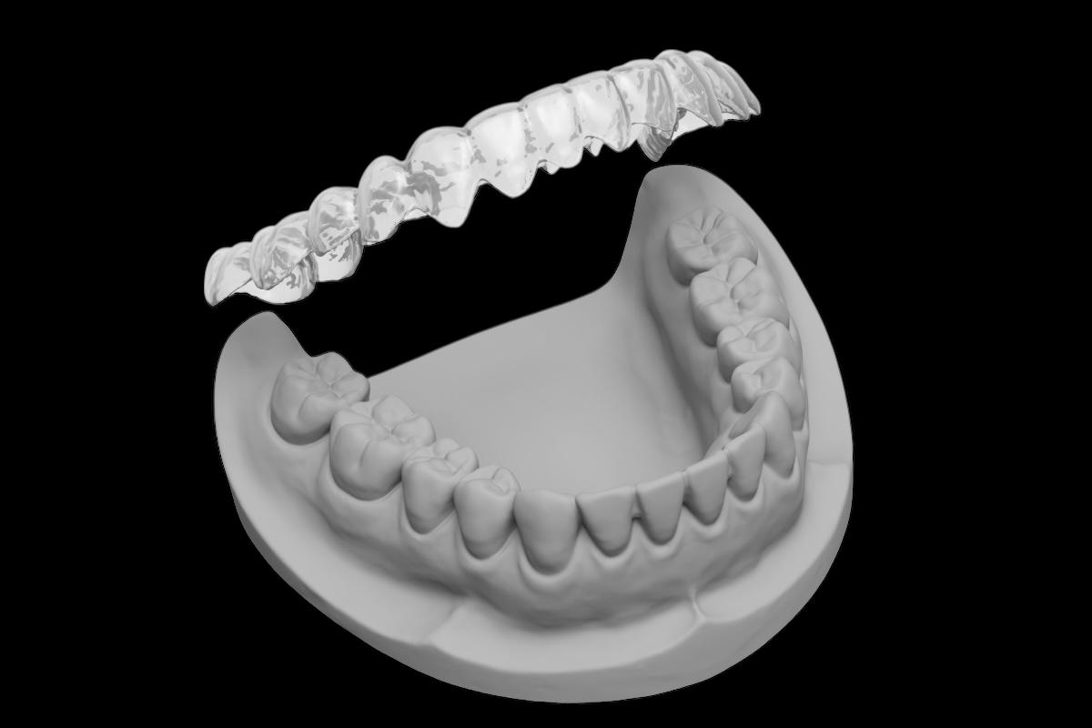 Gutiere dentare