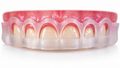 Ghid gingivectomie printat