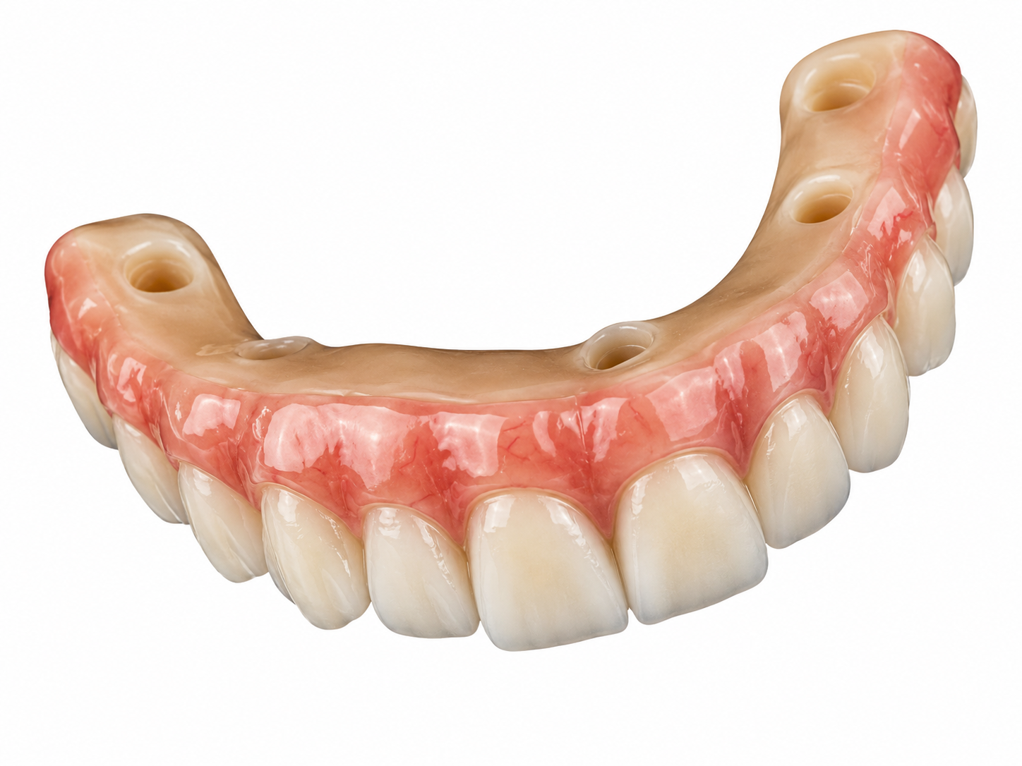 PMMA Implant