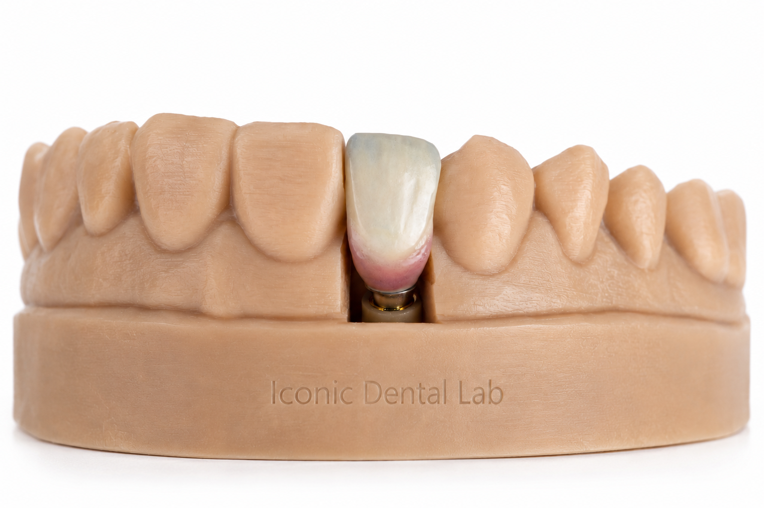 Coroane cimentate pe implant