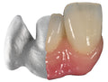 Metalo-ceramică full contur